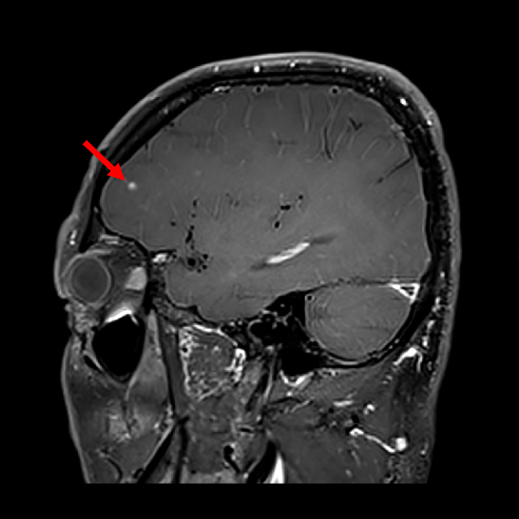 治療前MRI画像