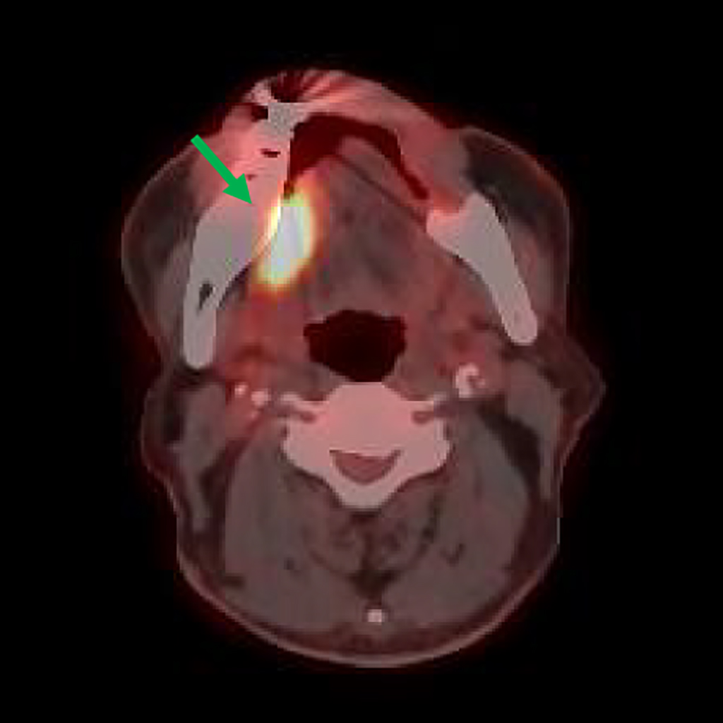 治療前PET-CT画像