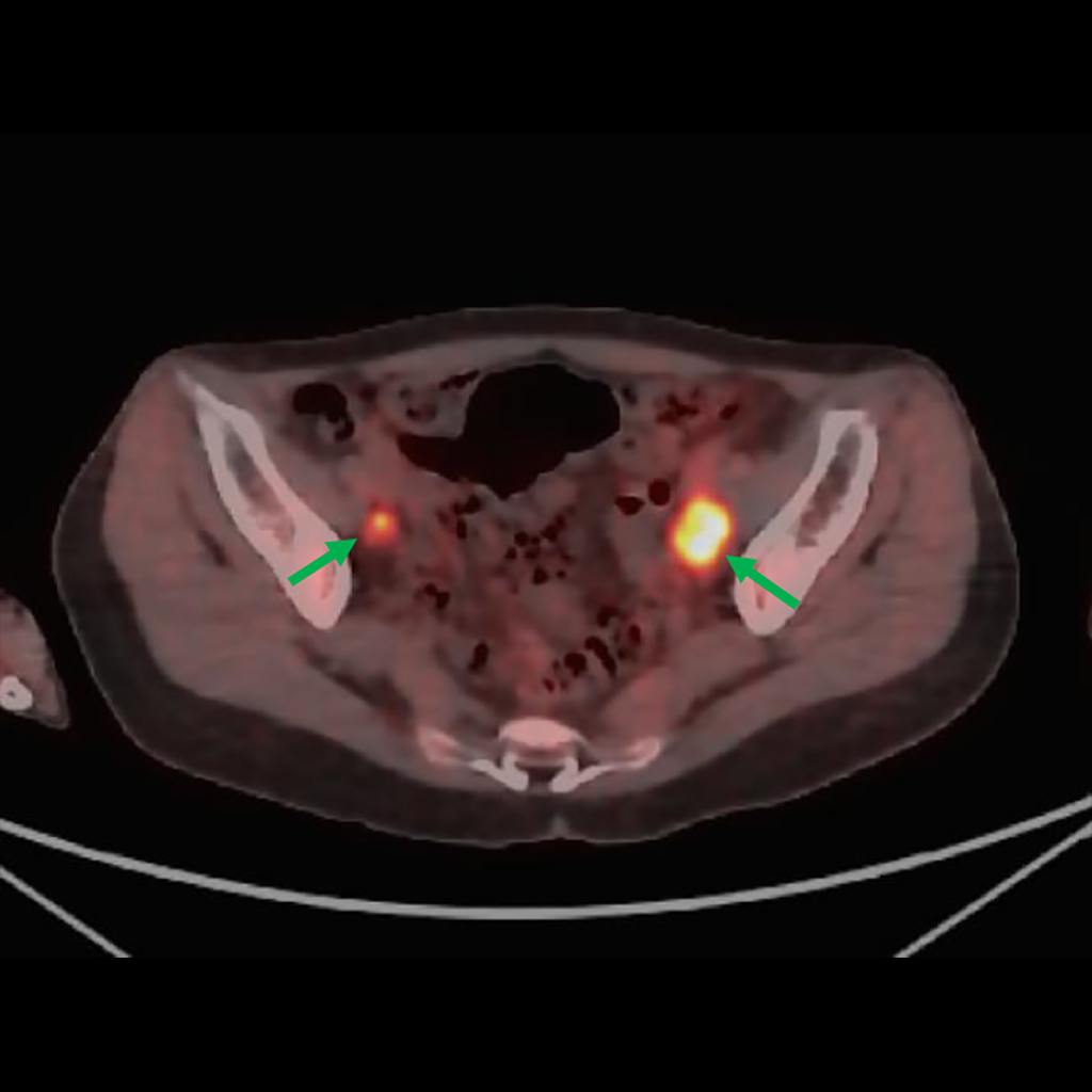 治療前PET-CT画像 (リンパ節転移)